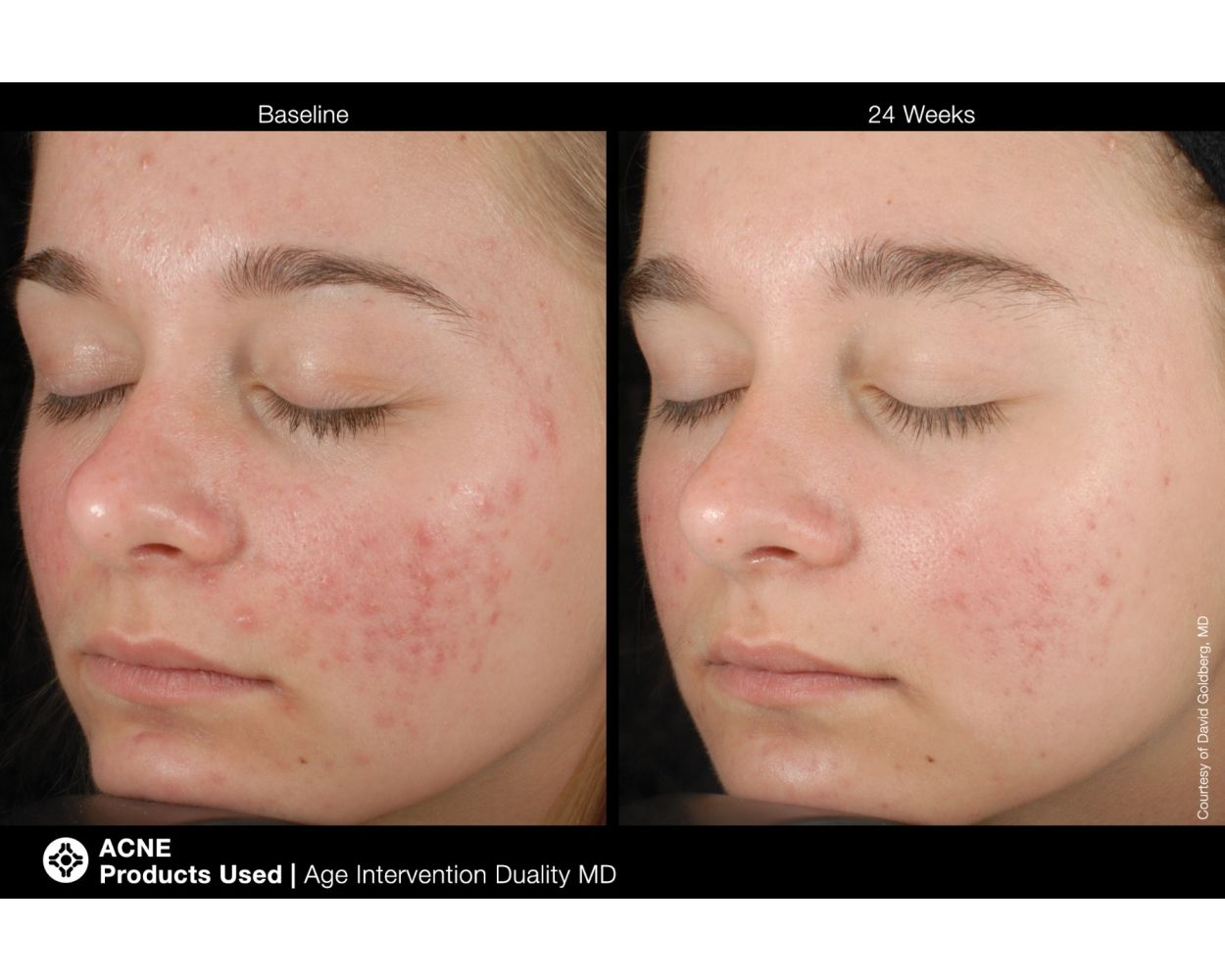 Age Intervention™ Duality™ MD