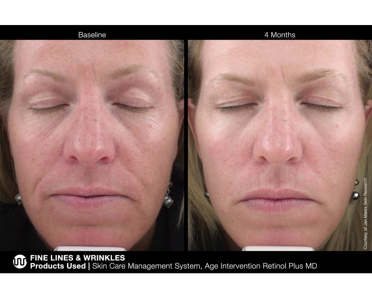 Age Intervention™ Retinol Plus MD