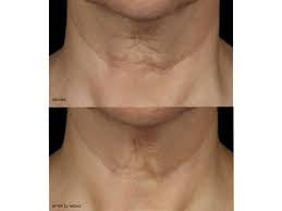 Nectifirm® ADVANCED 0.5 OZ - Neck Cream