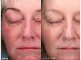 All Calm Clinical Redness Corrector SPF 50