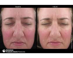 Rosalieve Redness Reducing Comples